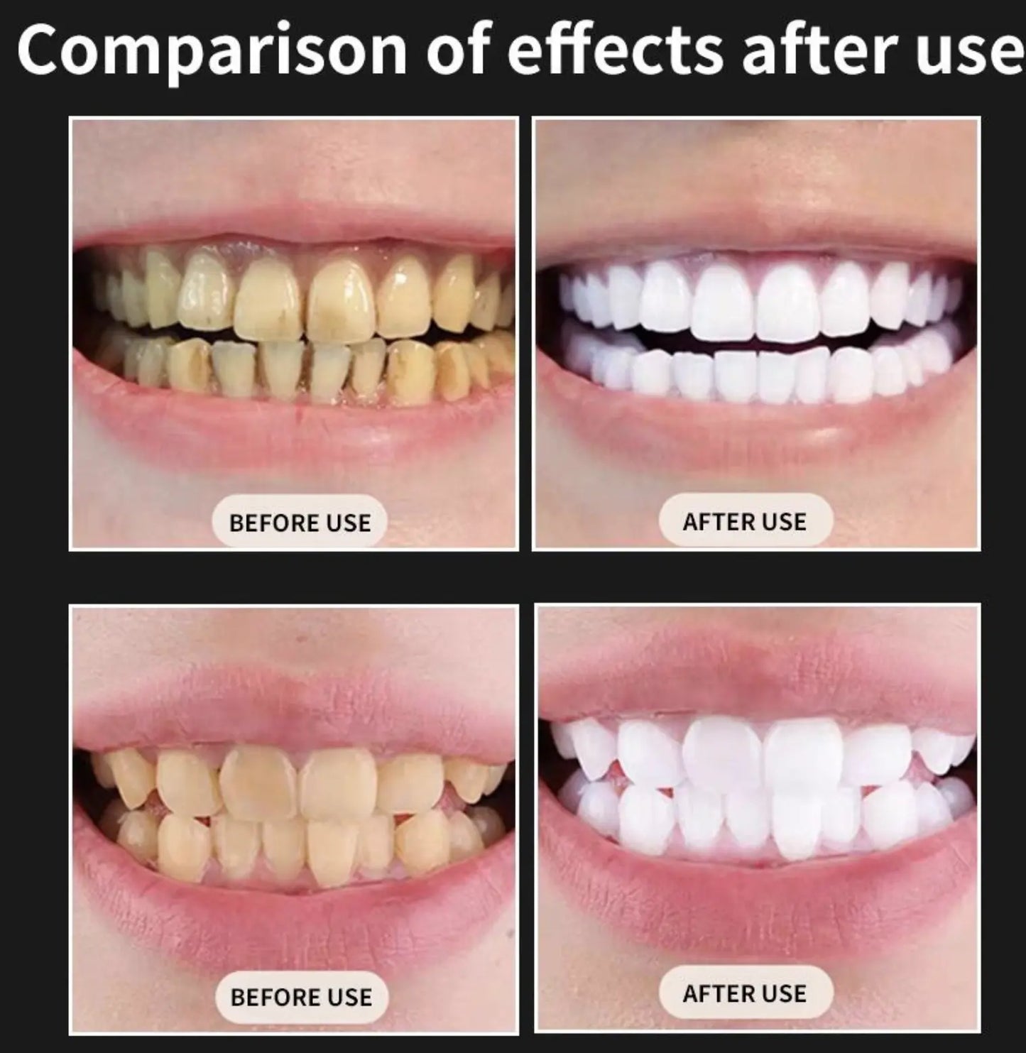 Smile Professional whitening kit